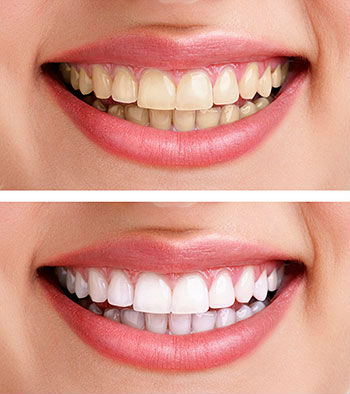 изменение цвета зубов после чистки
