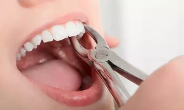 удаление зуба мудрости у пациента