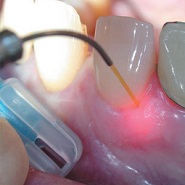лазером имплантируют зубы