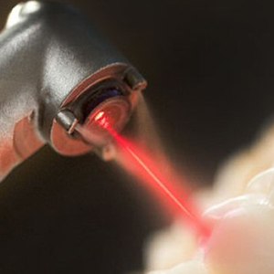 лазер для зубов