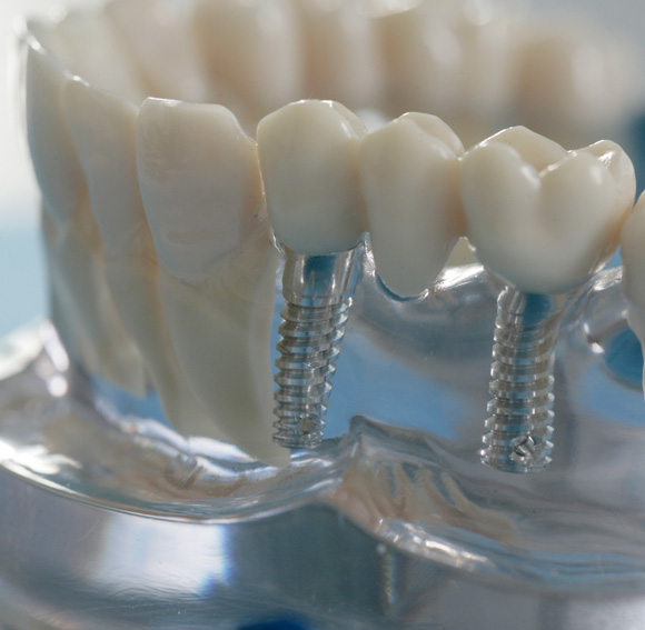 металлический зубной протез