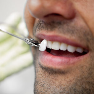 Проведение реставрации зубного ряда