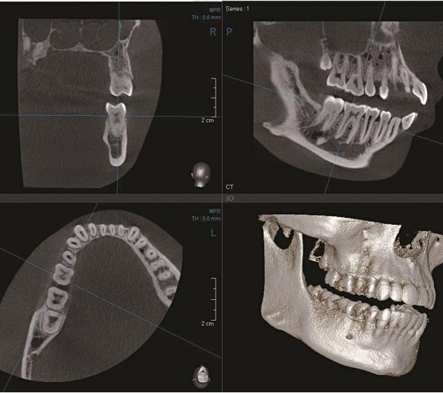 Результат компьютерной томографии зубов